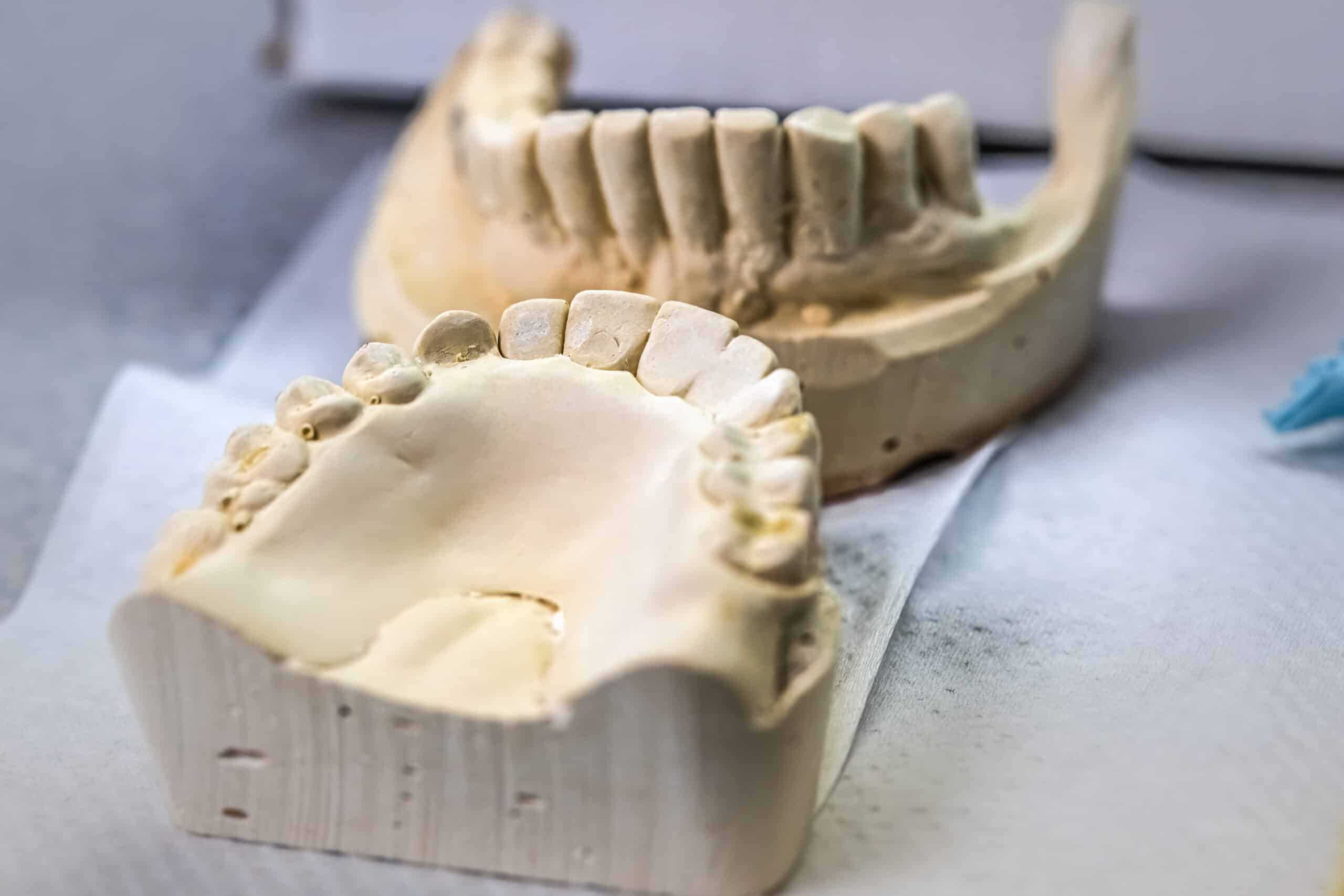 dental impression mold by Dr. Faye Licata